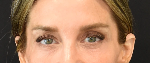 Eyelid Surgery Patient 23 Set 1 Before